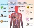 Allergy - Causes - Symptoms - Diagnosis - Treatment - FAQs - Videos Allergy - Causes - Symptoms - Diagnosis - Treatment - FAQs - Videos