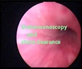 Ureteroscopy - Overview Ureteroscopy - Overview
