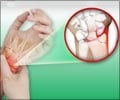 Wrist Pain Symptom Evaluation | Symptom Evaluation of Wrist Pain Wrist Pain Symptom Evaluation | Symptom Evaluation of Wrist Pain