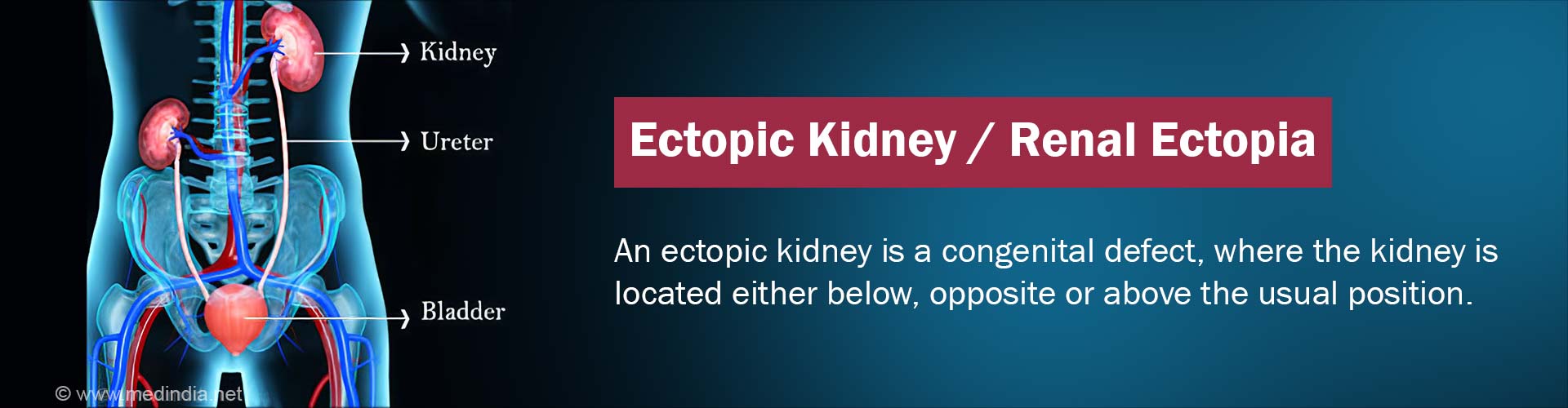 Ectopic Kidney | Renal Ectopia - Causes, Symptoms, Diagnosis, Treatment, Complications