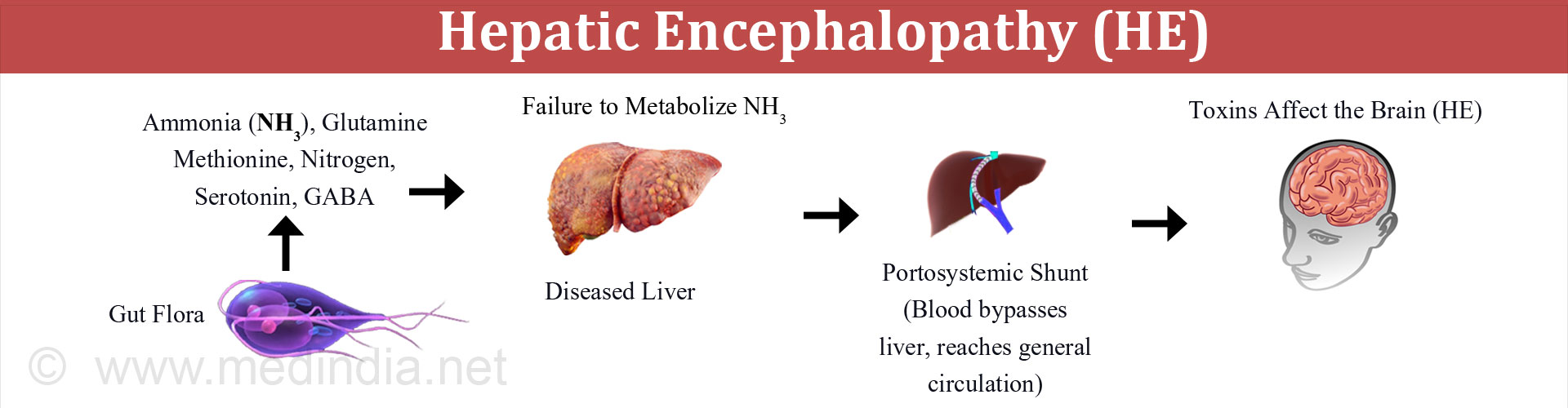 Hepatic Encephalopathy - Causes, Types, Stages, Symptoms, Diagnosis ...