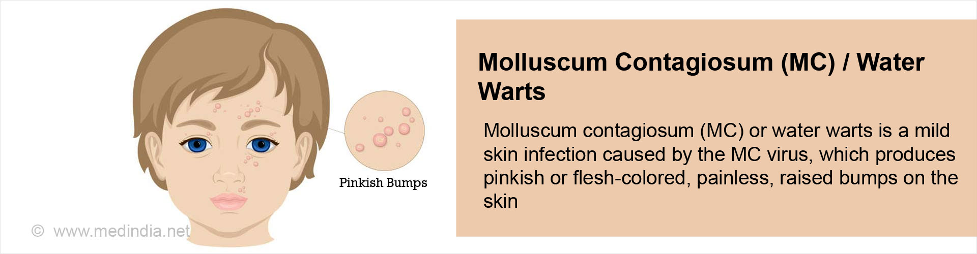 Molluscum Contagiosum Water Warts Causes Symptoms Diagnosis