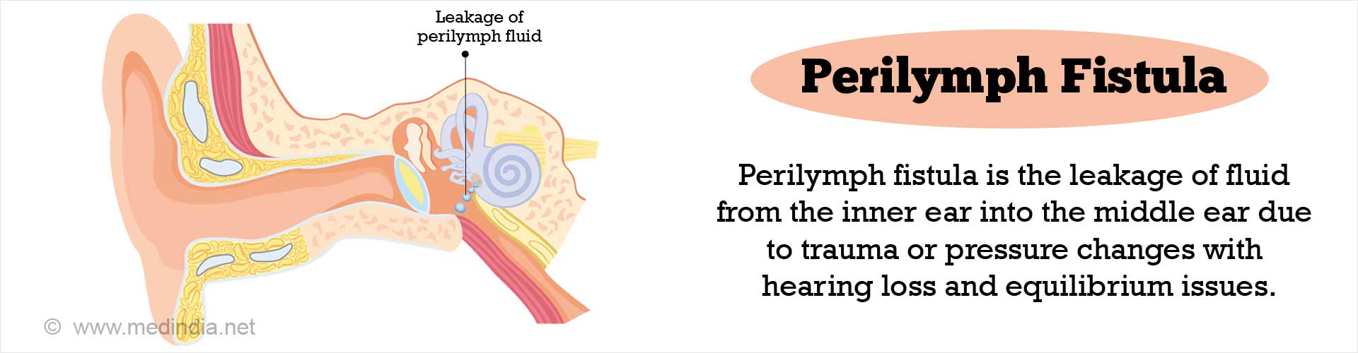 Perilymph Fistula
