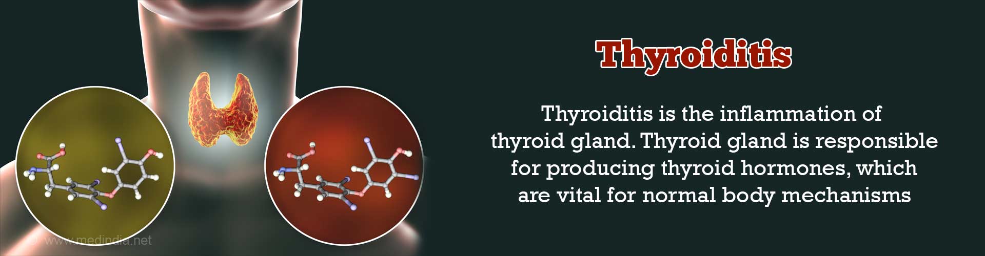 chronic thyroiditis