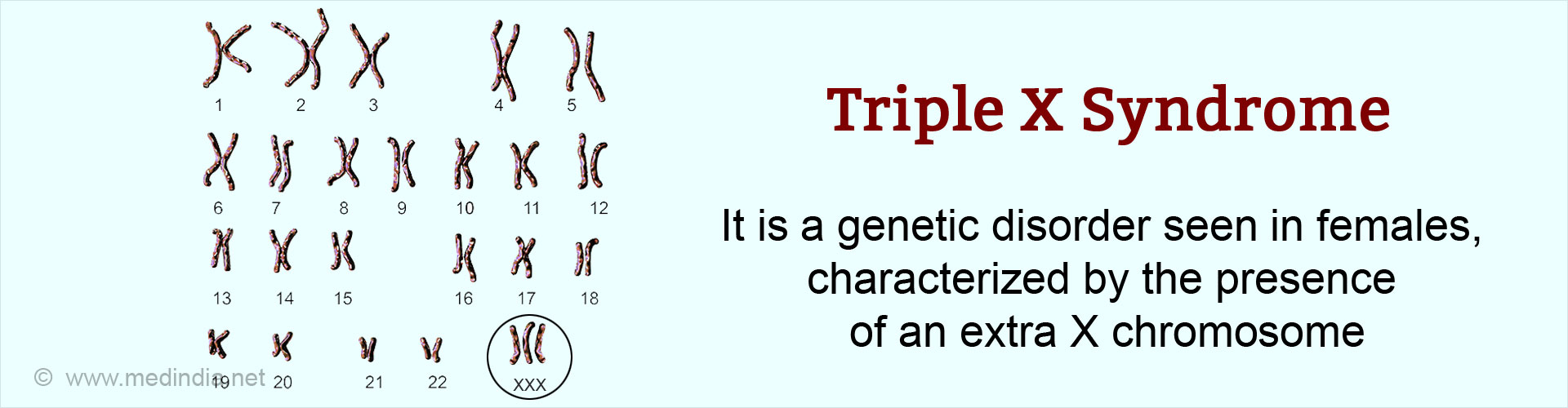 Triple X Syndrome Causes Symptoms Diagnosis Treatment And Prevention