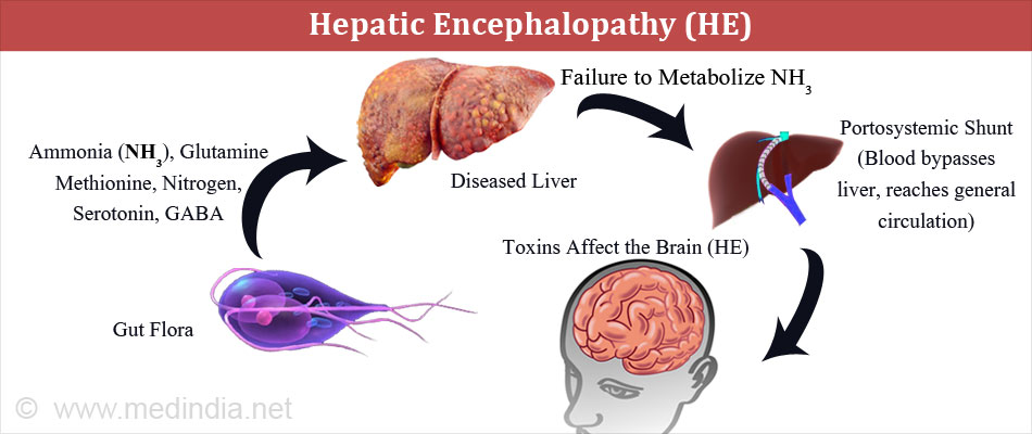 Hepatic Encephalopathy - Causes, Types, Stages, Symptoms, Diagnosis ...