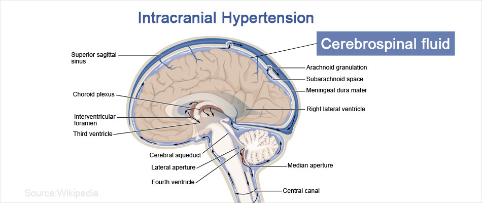clinical presentation of benign intracranial hypertension