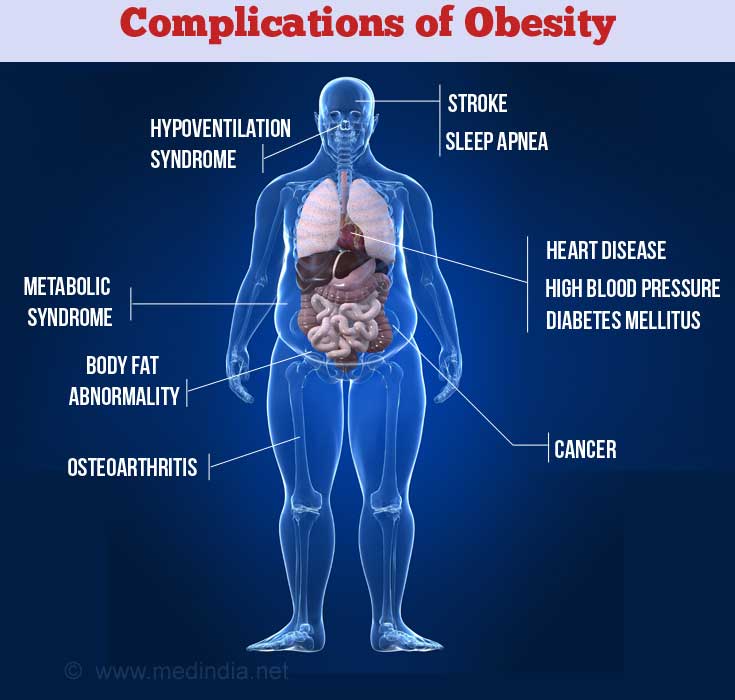 Complications of Obesity