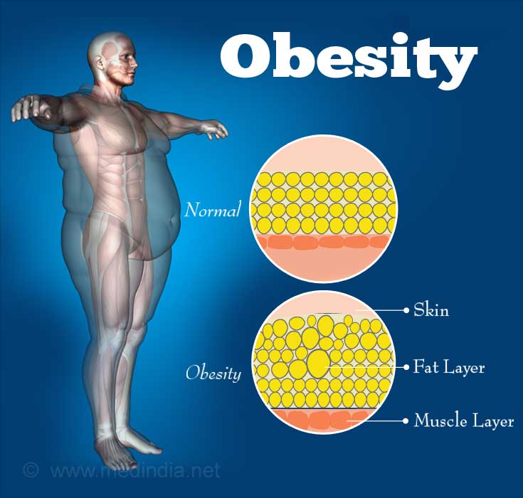Obesity - Excess Body Fat