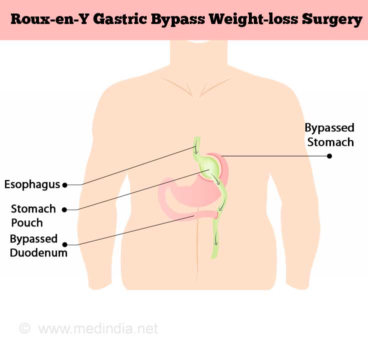 Roux-en-Y Gastric Bypass Weight-loss Surgery