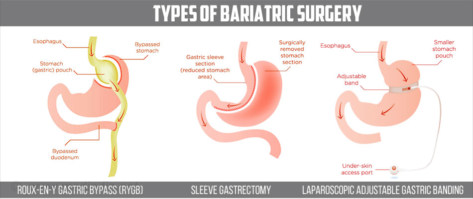 Bariatric Surgery - Short Term and Long Term Outcomes
