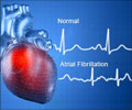 Quiz on Atrial Fibrillation