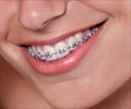 Quiz on Dental Braces