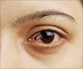 Quiz on Eye Cancer