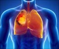 Quiz on Lung Cancer (Advance)