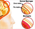 Quiz on Meningitis