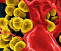 Quiz on Methicillin Resistant Staphylococcus Aureus (MRSA)