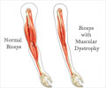 Quiz on Muscular Dystrophy