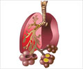 Quiz on Pneumonia