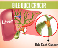 Test Your Knowledge on Bile Duct Cancer