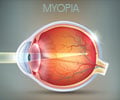 Test Your Knowledge on Short-sightedness (Myopia)