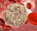 Test Your Knowledge on Blood Cancer