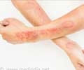 Test Your Knowledge on Fungal Infections Test Your Knowledge on Fungal Infections