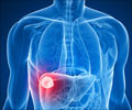 Test Your Knowledge on Liver Cancer