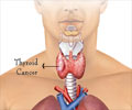 Quiz on Thyroid Cancer