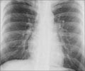 Quiz on Tuberculosis