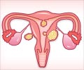 Quiz on Uterine Fibroids Quiz on Uterine Fibroids