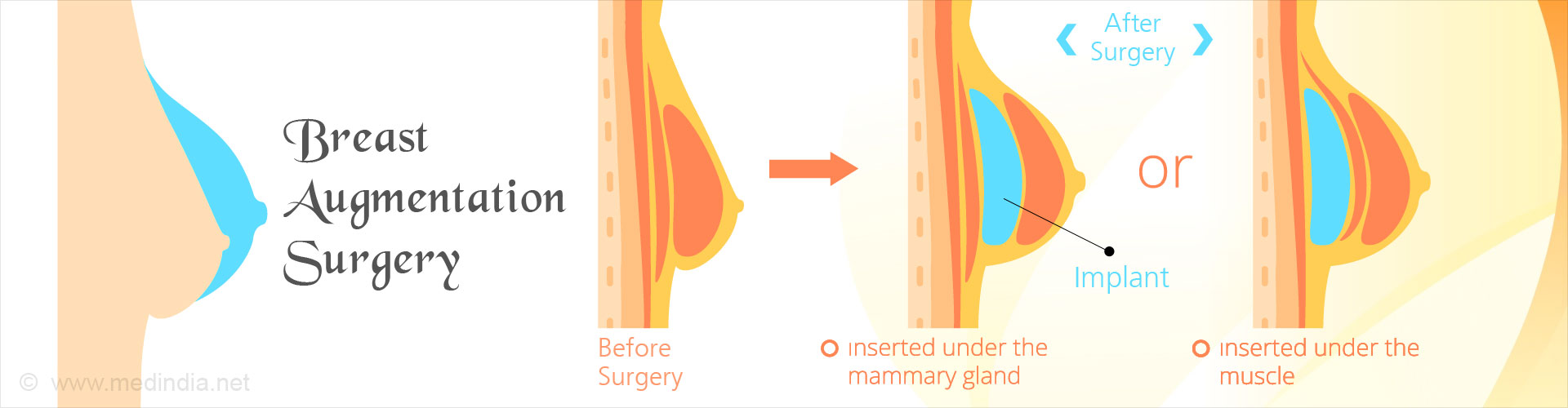 Breast Augmentation Chart