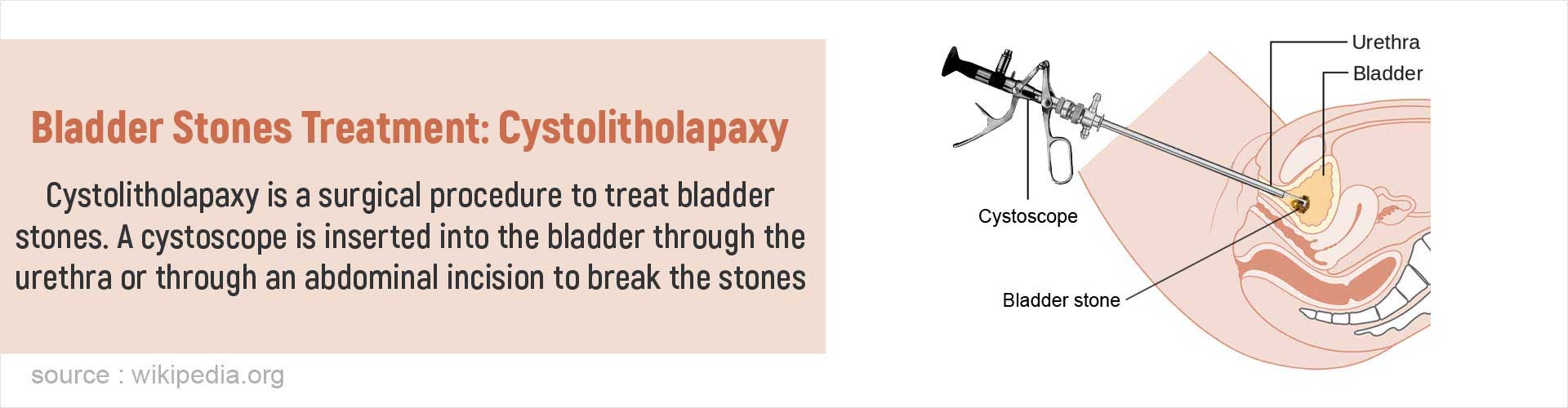 Bladder Stones Treatment: Cystolitholapaxy
