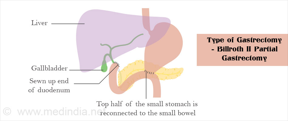 Type of Gastrectomy - Billroth II Partial Gastrectomy