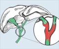 Bile Duct Cancer - Infographic