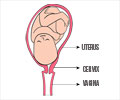 Cervical Ripening