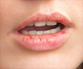 Home Remedies for Chapped Lips