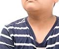 Dark Neck Patches in Kids: Hidden Warning Sign for Diabetes Risk Dark Neck Patches in Kids: Hidden Warning Sign for Diabetes Risk