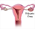 Top 12 Facts on Polycystic Ovarian Syndrome