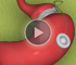 Bariatric Surgery - Gastric Banding
