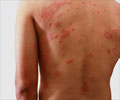 Home Remedies for Dermatitis