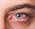 Home Remedies for Pink Eye