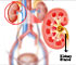 Kidney Stones - Home Remedies