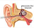 Labyrinthectomy