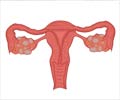 Ovarian Hyper Stimulation Syndrome (OHSS)