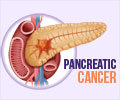 Pancreatic Cancer - Infographic