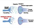 Quiz on Parkinsons Disease