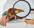 Test Your Knowledge on Liver Transplantation