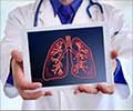 Test Your Knowledge on Lung Transplantation