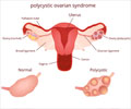 Test Your Knowledge on Polycystic Ovarian Syndrome (PCOS)
